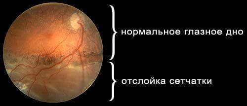 нормальное глазное дно и поврежденное