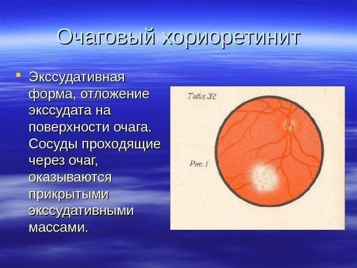 ochagovyj-xorioretinit