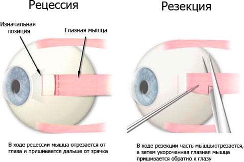 operatsii-pri-kosoglazii-1
