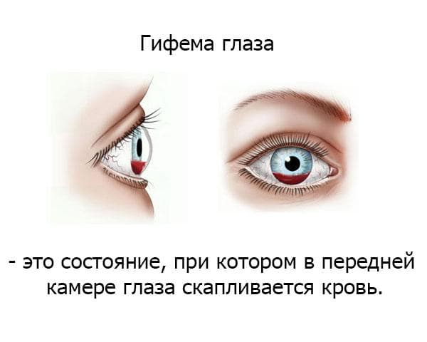 oprdelenie-gifemy-glaza