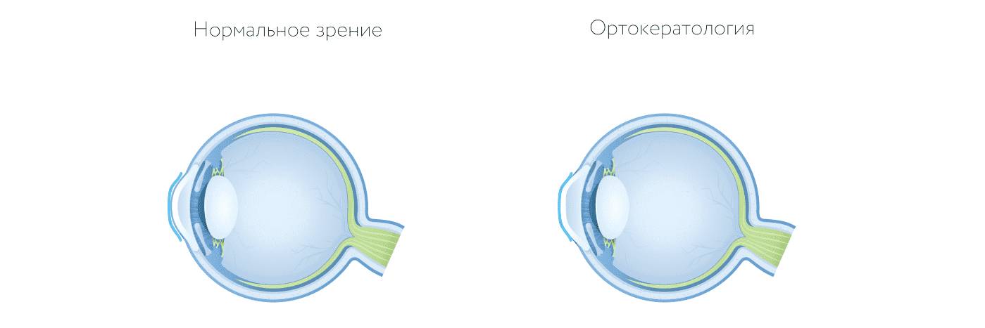 ортокератологические линзы