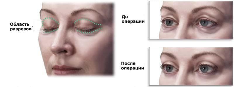 Хирургическая коррекция птоза