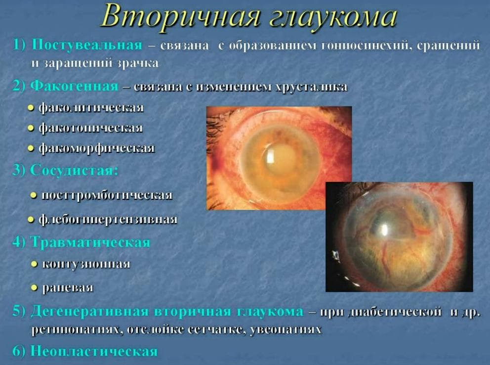 osobennosti-vtorichnoj-glaukomy