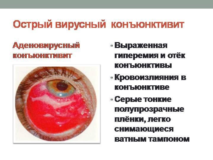 симптомы вирусного конъюнктивита