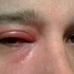 отек верхних век по утрам причины