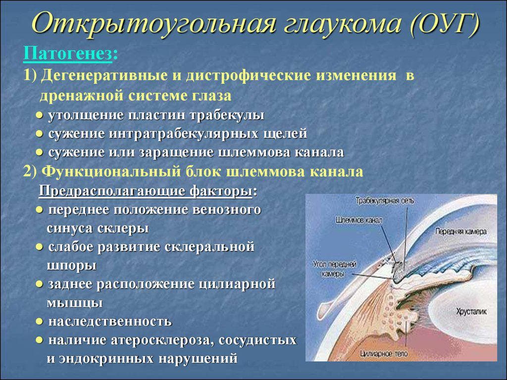 otkrytougolnaya-glaukoma