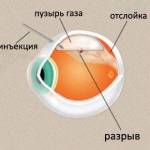 отслоение сетчатки глаза