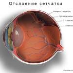 отслоение сетчатки