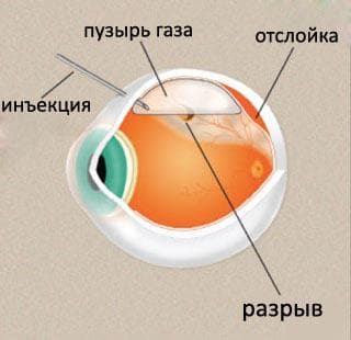 Причины отслоение сетчатки глаза