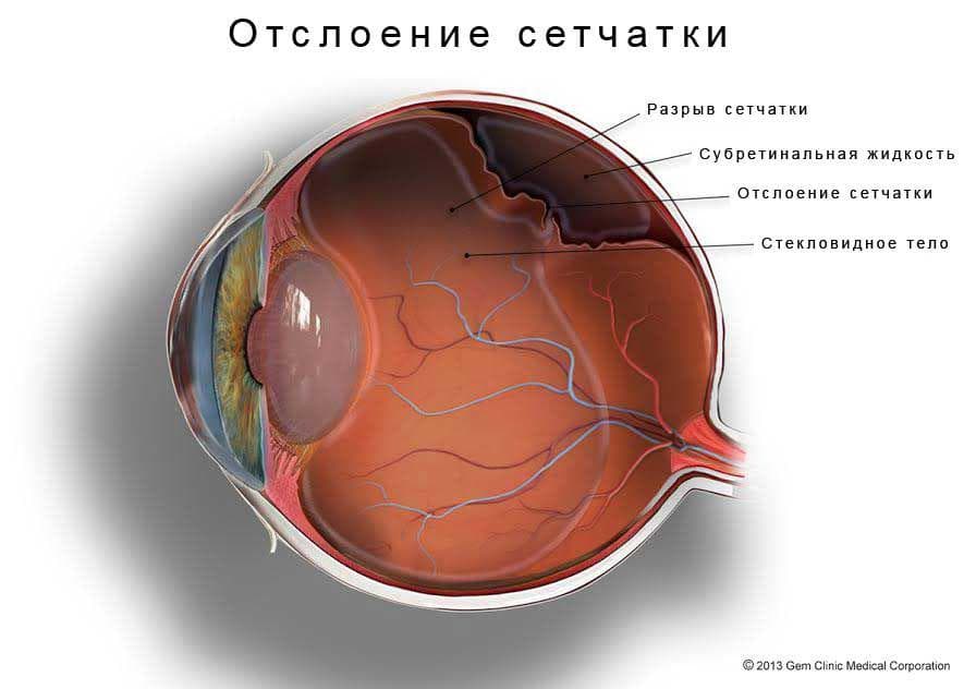 Отслоение сетчатки глаза: причины, симптомы, что это такое, лечение народными средствами, послеоперационный период, по Болотову, чем грозит, операция