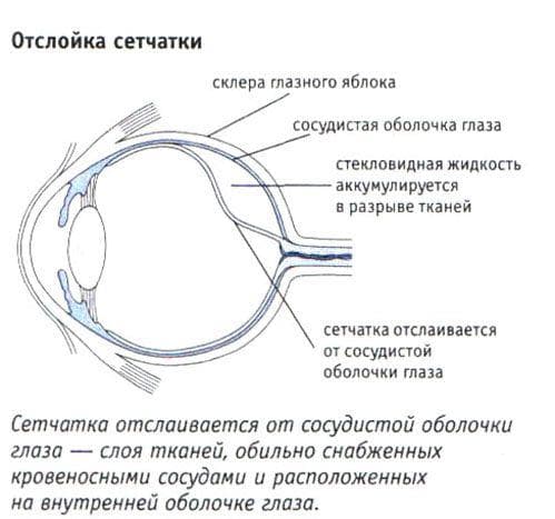 Отслоение сетчатки глаза: причины, симптомы, что это такое, лечение народными средствами, послеоперационный период, по Болотову, чем грозит, операция