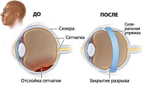 Отслоение сетчатки глаза: причины, симптомы, что это такое, лечение народными средствами, послеоперационный период, по Болотову, чем грозит, операция