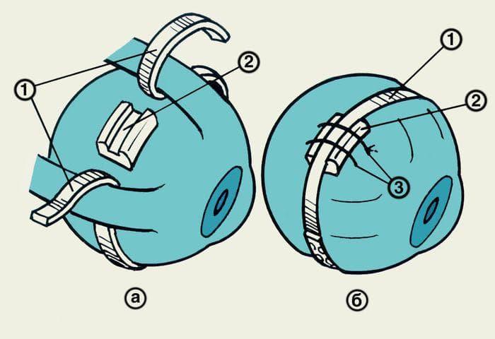Признаки отслоения сетчатки глаза что это такое, сиптомы, лечение народными средствами, послеоперационный период, последствия