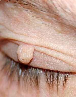 papilloma-na-veke