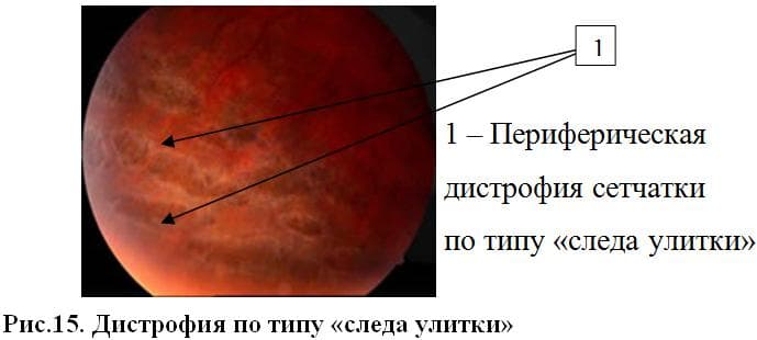 perifericheskaya-distrofiya-po-tipu-sleda-ulitki