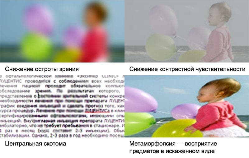 Симптомы ВМД