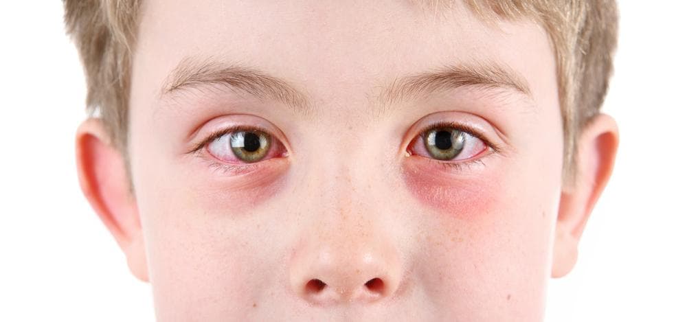 pink_eye_2-1