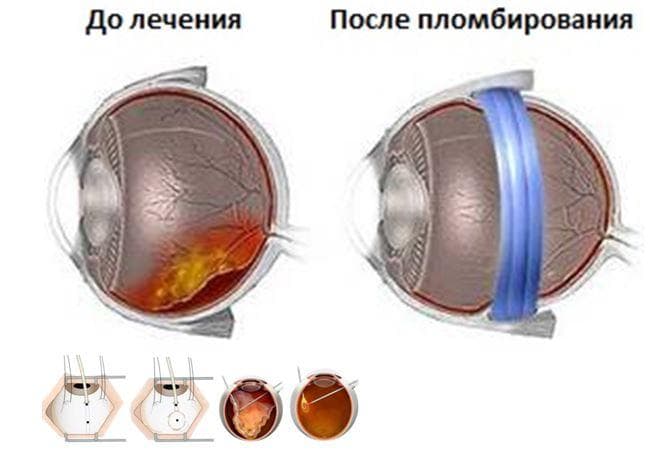 Пломбирование глаза для устранения воздушного мешка