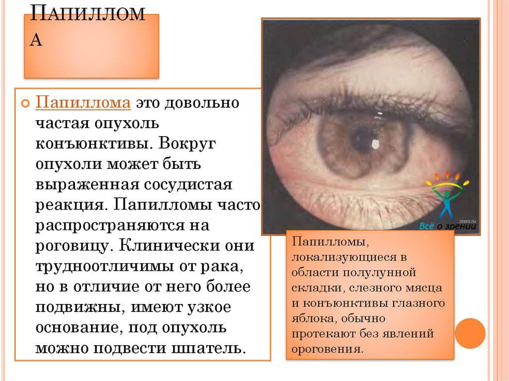 pochemu-obrazuetsya-papilloma-na-veke