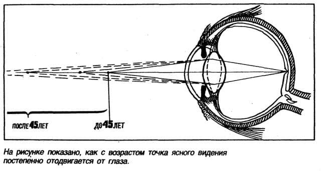 Возрастная дальнозоркость или пресбиопия