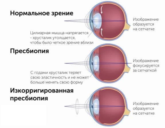 схема пресбиопии
