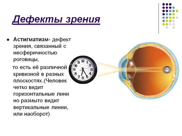 prichiny-vozniknoveniya-astigmatizma