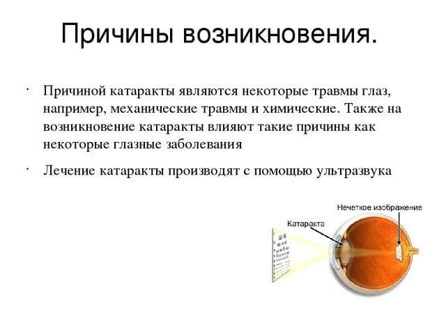 prichiny-vozniknoveniya-katarakty