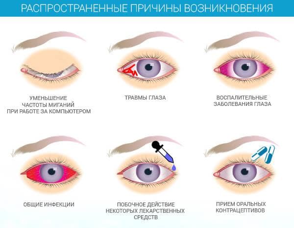 prichiny-vozniknoveniya-sindroma-suxogo-glaza