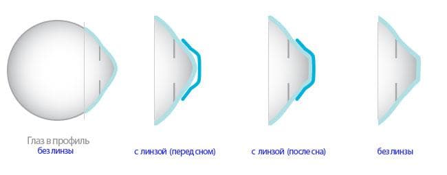 принцип действия ночной линзы