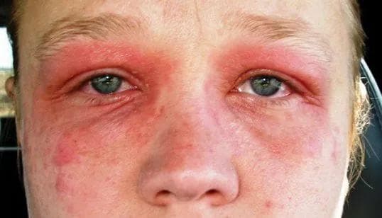 proyavlenie-allergii-na-glazax