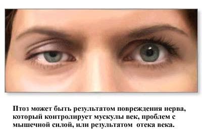 Причины птоза верхнего века