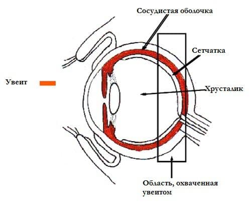 схема увеита