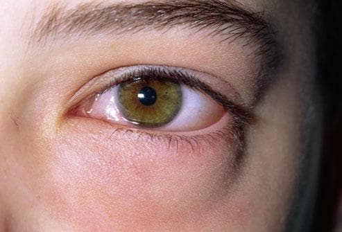 simptomy-allergicheskoj-reakcii-na-glazax