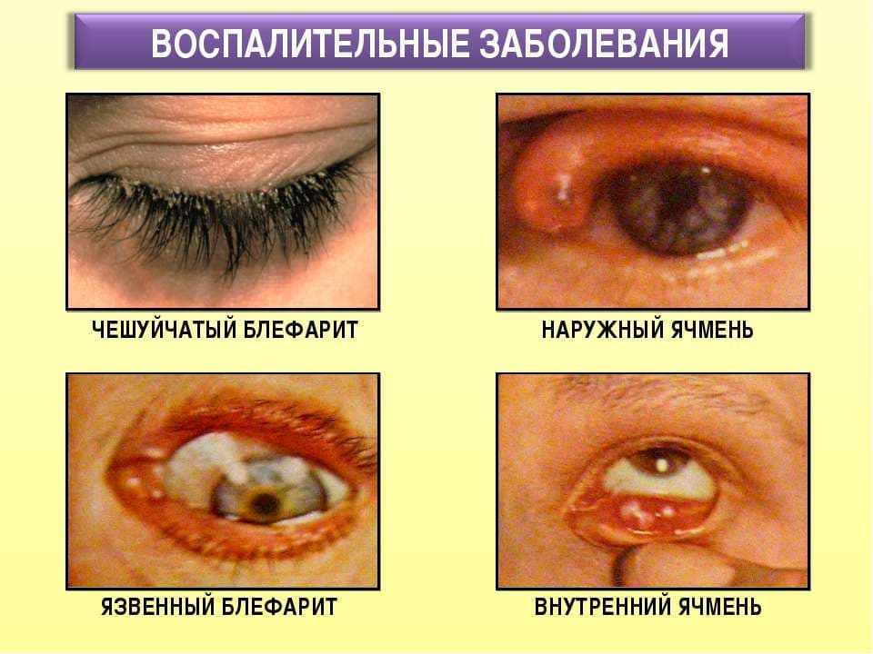 симптомы блефарита