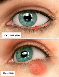 симптомы халязиона