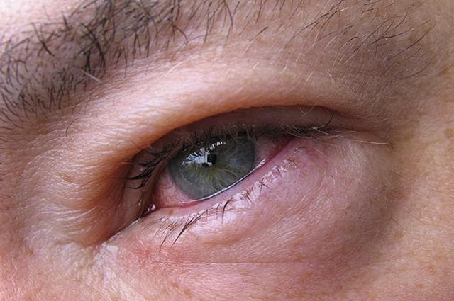 heavily inflammed eye