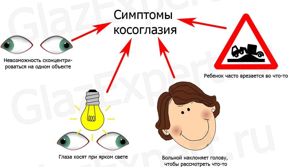 Симптомы косоглазия