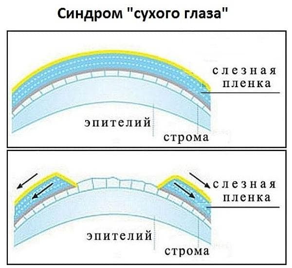 Определение симптома "сухого" глаза