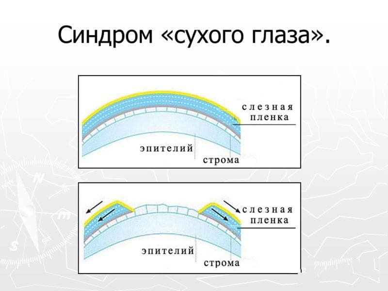 sindrom-suxogo-glaza