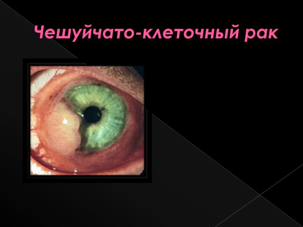 Чешуйчато клеточный рак