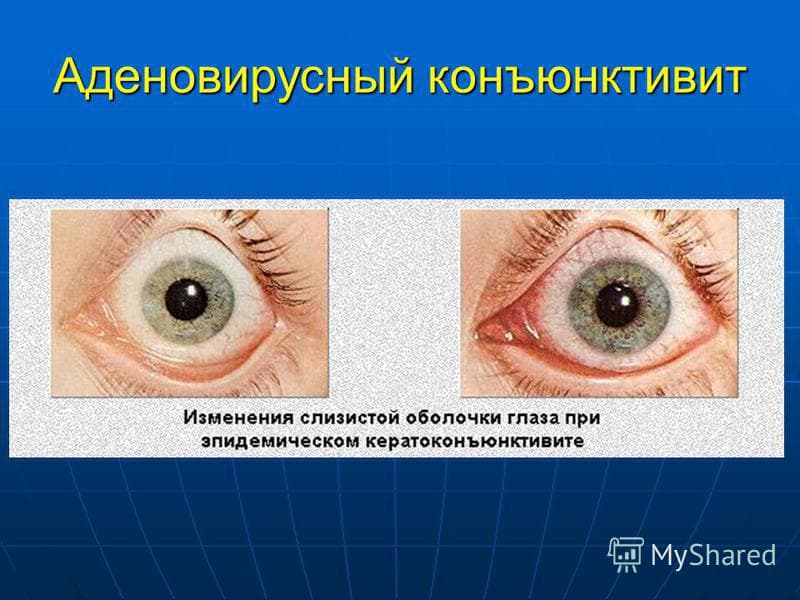 аденовирусный конъюктивит