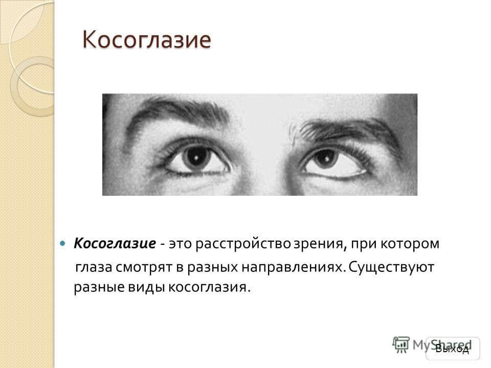 Косоглазие