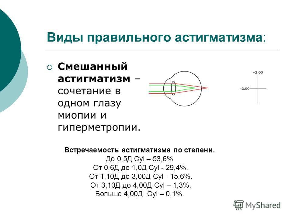 Смешанный астигматизм