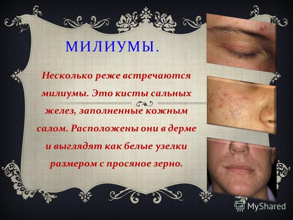 Милиумы