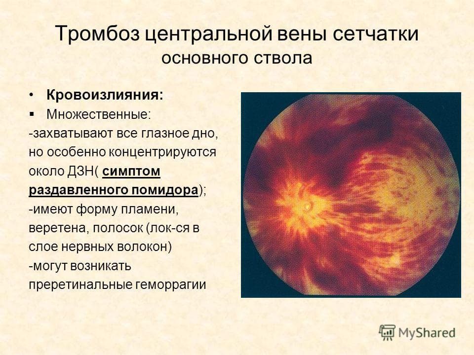 Тромбоз осложнения