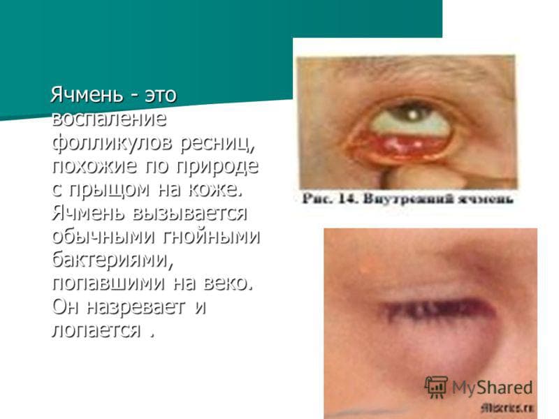 ячмень определение