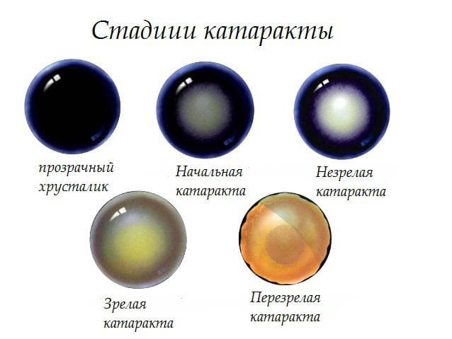 стадии катаракты