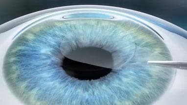 sut-operacii-lasik
