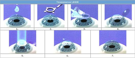 технология LASIK