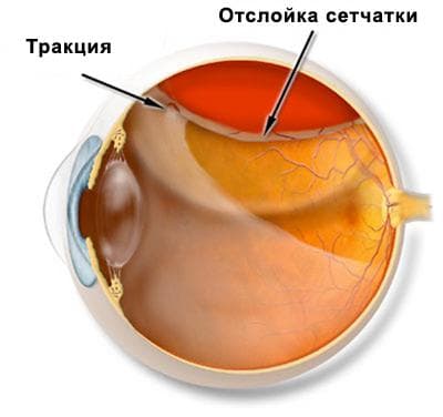 тракционное отслоение сетчатки